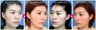 韓式隆鼻+雙眼皮手術  人生再出發