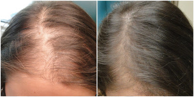 called PRP Platelet Rich Plasma Therapy effectively treats hair loss 