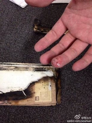 陸網友稱手指因小米2S官方電池自燃而遭灼傷。