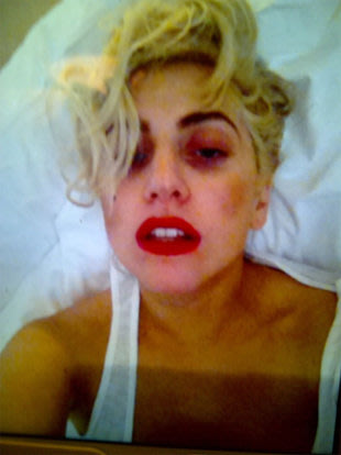 Lady Gaga Posting Foto Mata Lebam