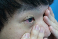 年終隱眼族眼疾暴增3成　醫：長時間配戴應注意透氧量
