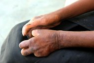 As mãos de um homem de Madagascar afetado pela lepra
