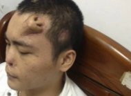 A man in China whose nose was damaged in an accident is growing a replacement nose on his forehead.