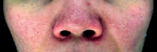 常見玫瑰痤瘡表現︰面頰兩旁及鼻頭位置泛紅