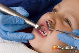 台灣5歲兒童蛀牙率高達近8成左右，也就是每5個5歲小孩中，就有4個罹患蛀牙。