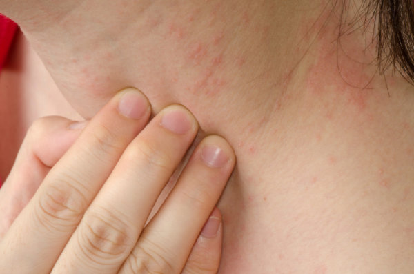 Hand Eczema - Dermatology Consultants - Skin Secrets