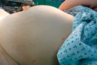 個案婦人肚子腫大彷彿懷孕，經電腦斷層檢查才發現有顆重達3公斤的子宮肌瘤。（圖片提供／亞東醫院）