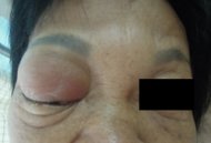 洗腎患者鼻竇炎　眼球爆凸險失明