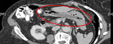 A CT scan of the 25-year-lodged pen. (British Medical Journal Case Reports)