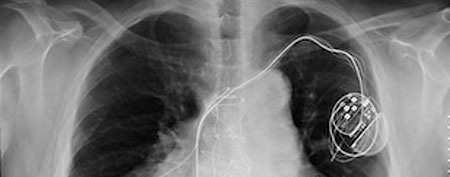 The chest x-ray of an Italian man who has two hearts. (Courtesy of Dr. Giacomo Mugnai)