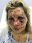 Delaware woman who says she was brutally beaten in the Dominican Republic sues resort for $3 million