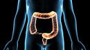 Colorectal Cancer Rates Rise Sharply in Younger US Adults