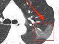 China is diagnosing coronavirus patients by looking for 'ground glass' in their lungs. Take a look at the CT scans.