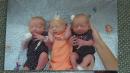 Woman thought she had kidney stones, gave birth to triplets
