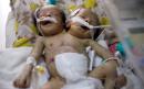 Conjoined twins die in Yemen due to lack of medical equipment
